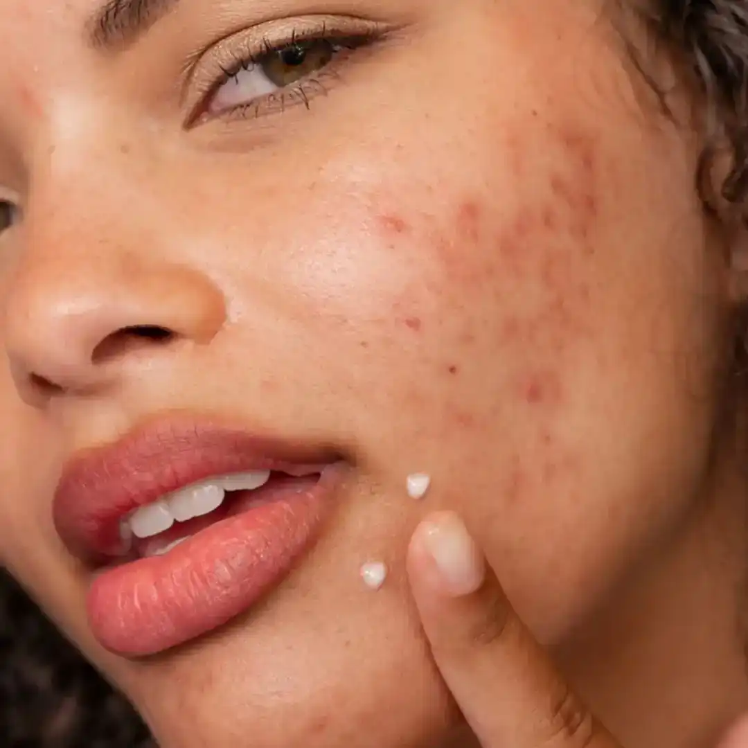 ACNE & OILINESS